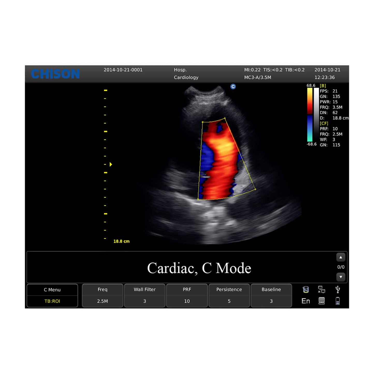 CHISON ECO5 Ultraschallgerät mit Farbdoppler