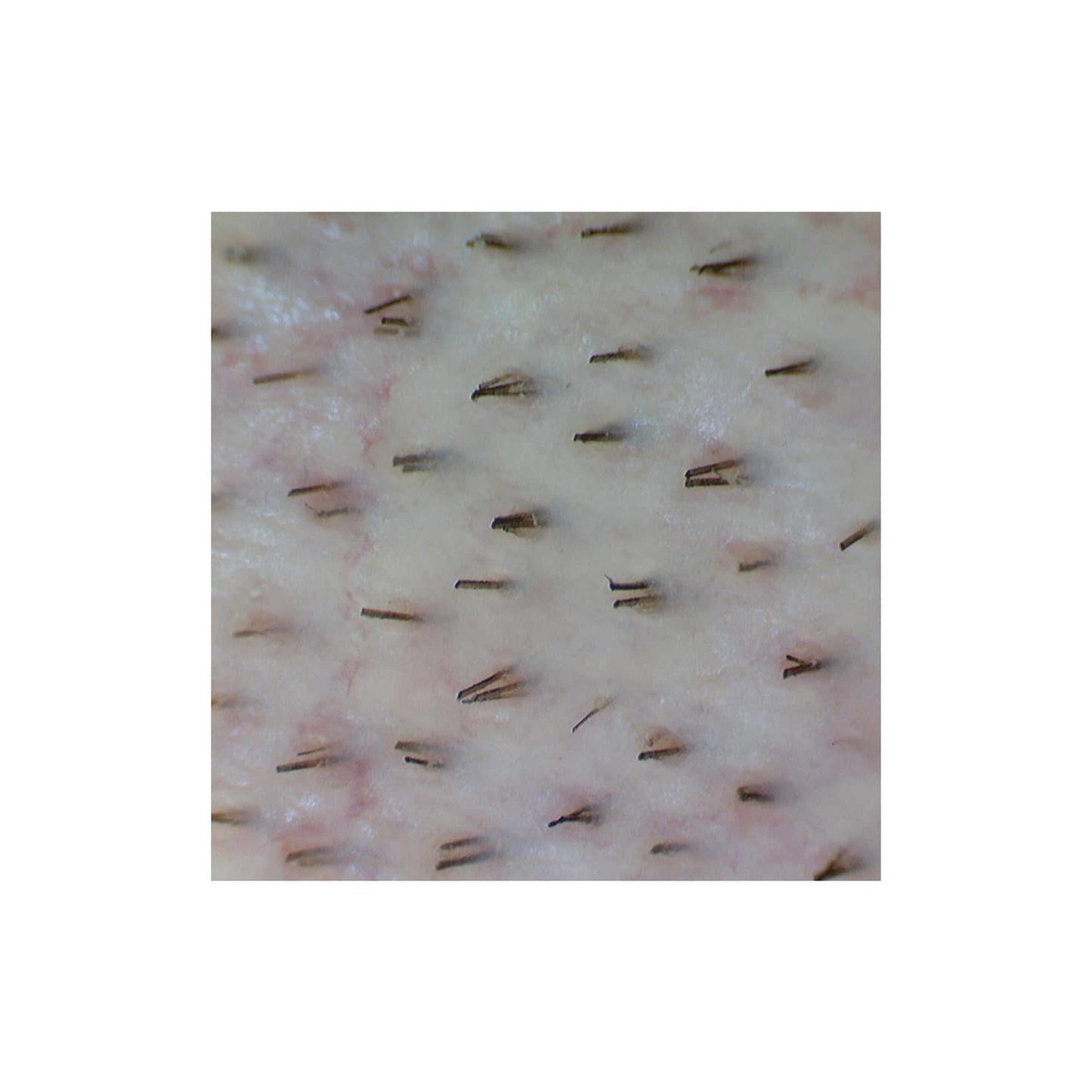 «Firefly» Videodermatoskop