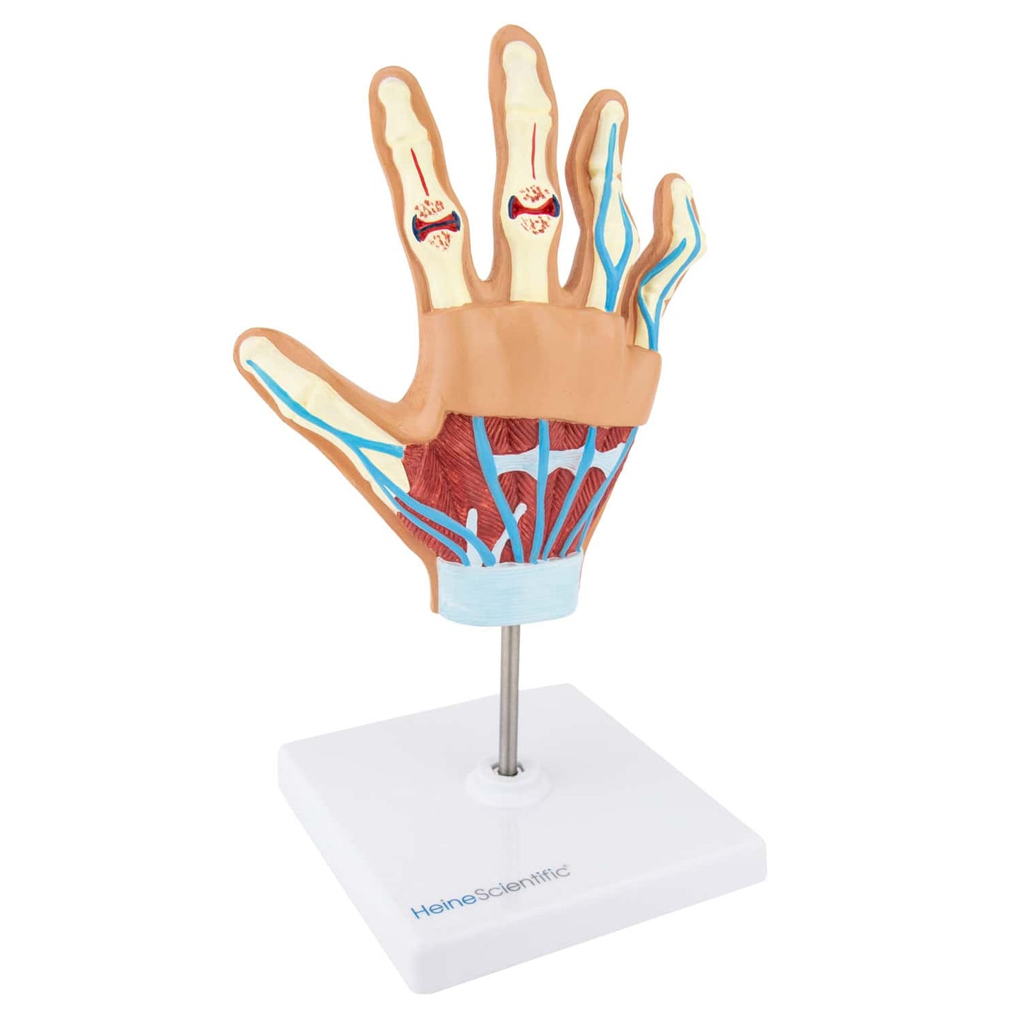Handmodell mit rheumatoider Arthritis