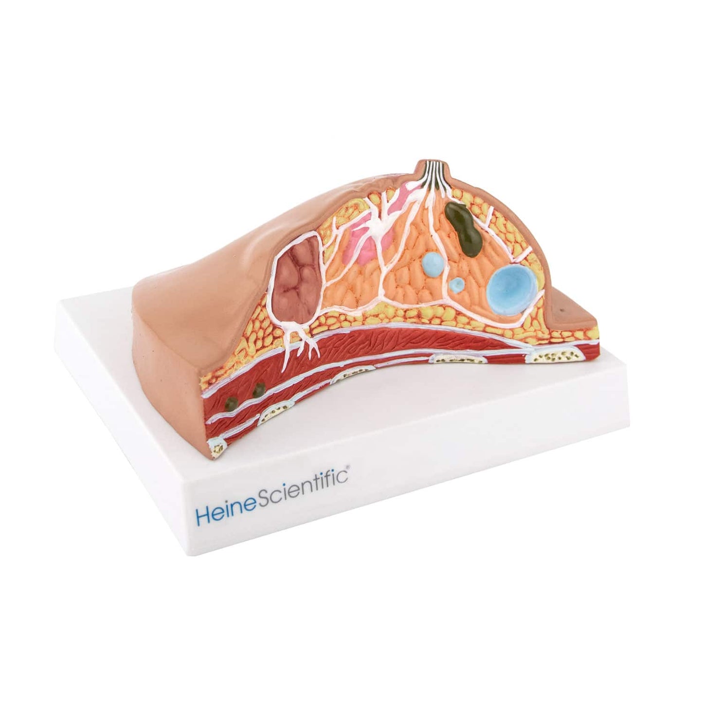 HeineScientific - Modell der weiblichen Brust mit Erkrankungen