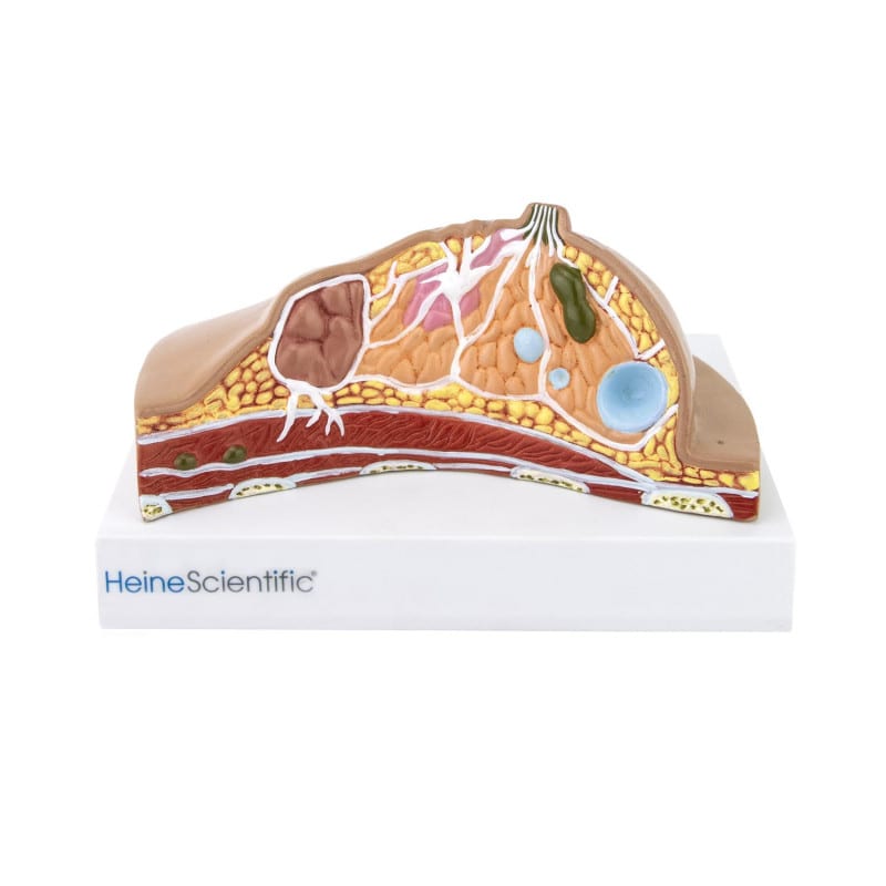 HeineScientific - Modell der weiblichen Brust mit Erkrankungen