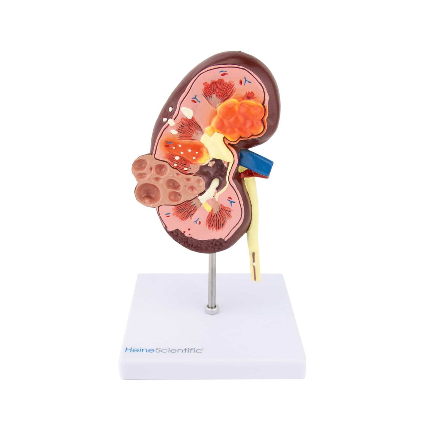 HeineScientific - Nierenmodell mit Erkrankungen