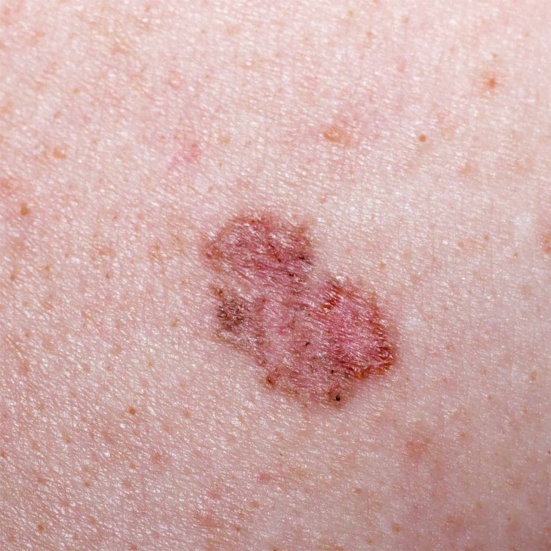 LuxaScope CCT Dermatoskop