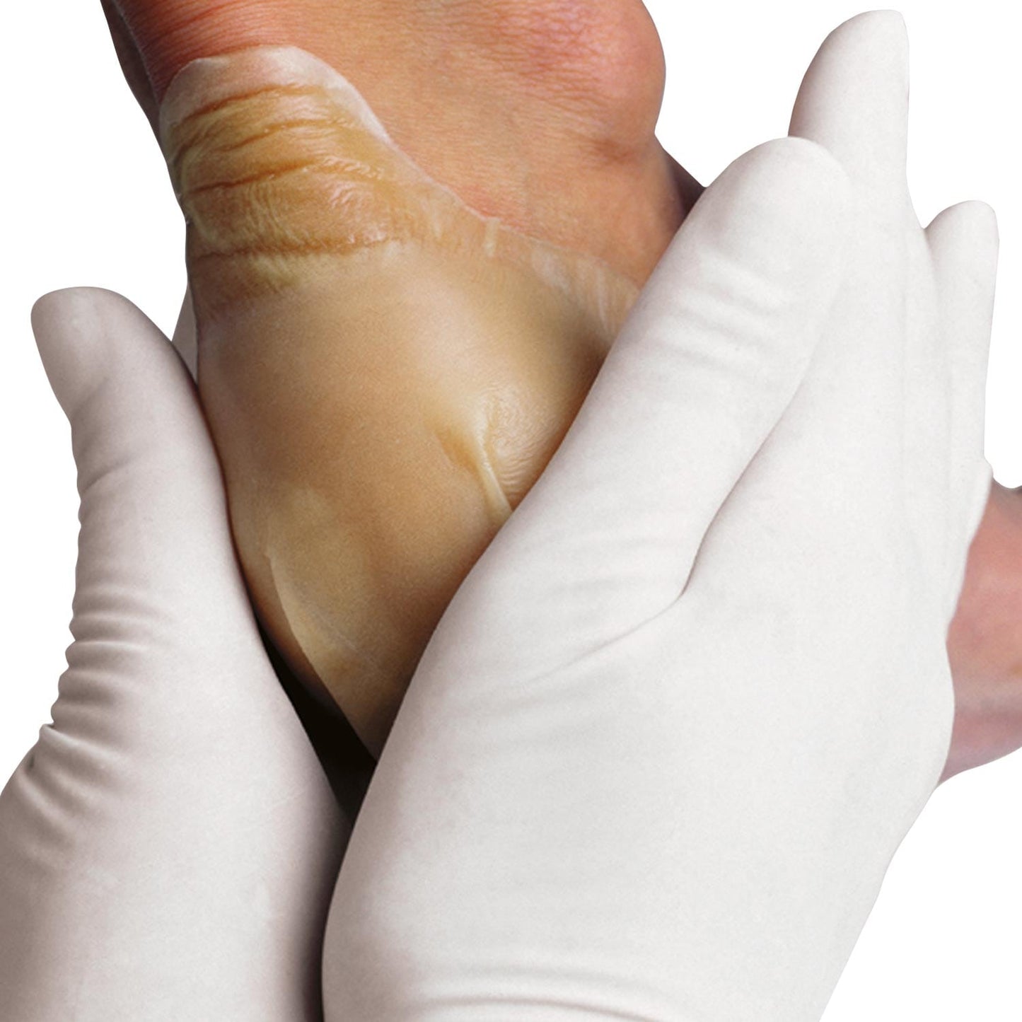 Hydrocoll Hydrokolloid-Verband