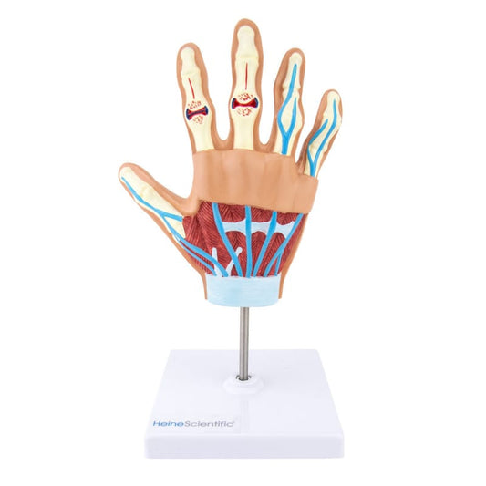 Handmodell mit rheumatoider Arthritis