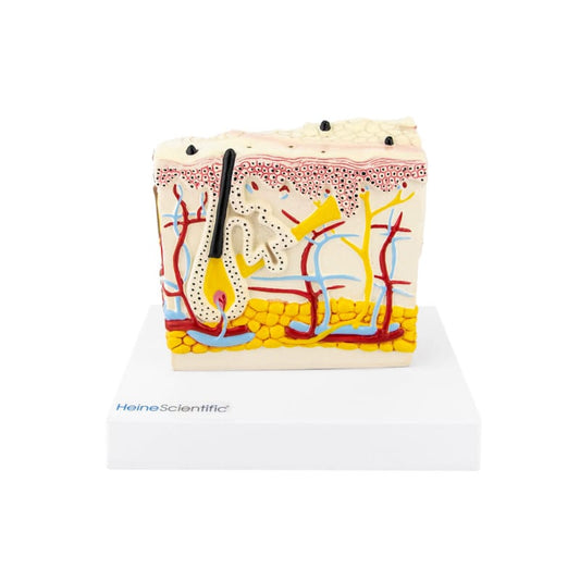 Hautmodell mit Psoriasis
