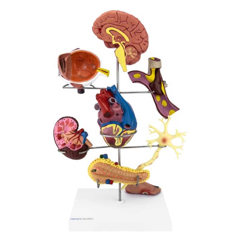 Modell der Diabetes-Folgen