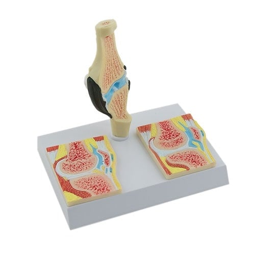 Rheumatisches Kniegelenk