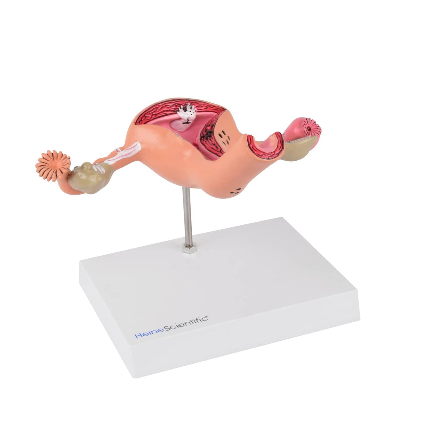 Uterus-Modell mit Erkrankungen