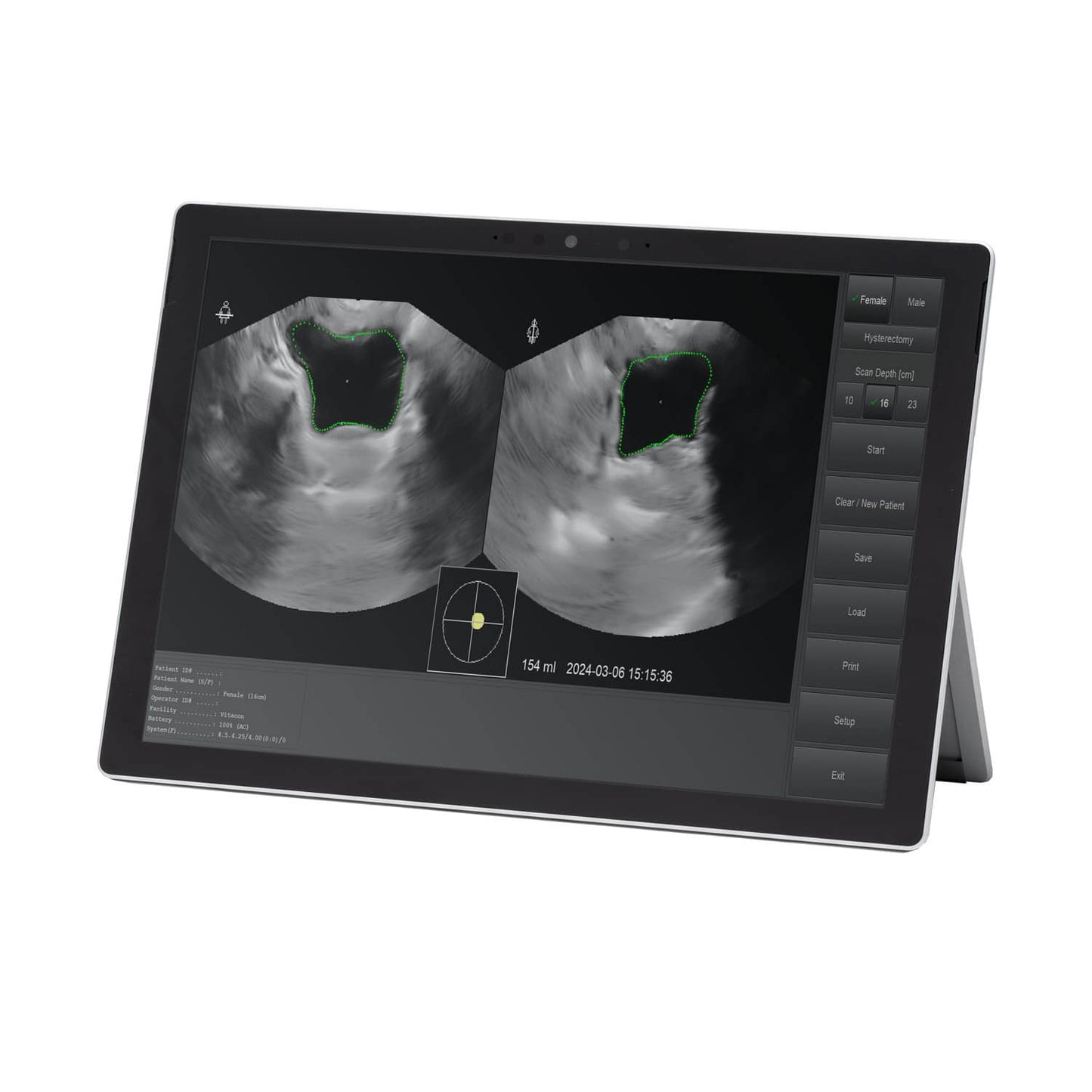 Vitascan LT Blasenscanner